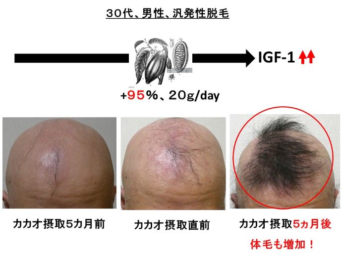 円形脱毛症　病院